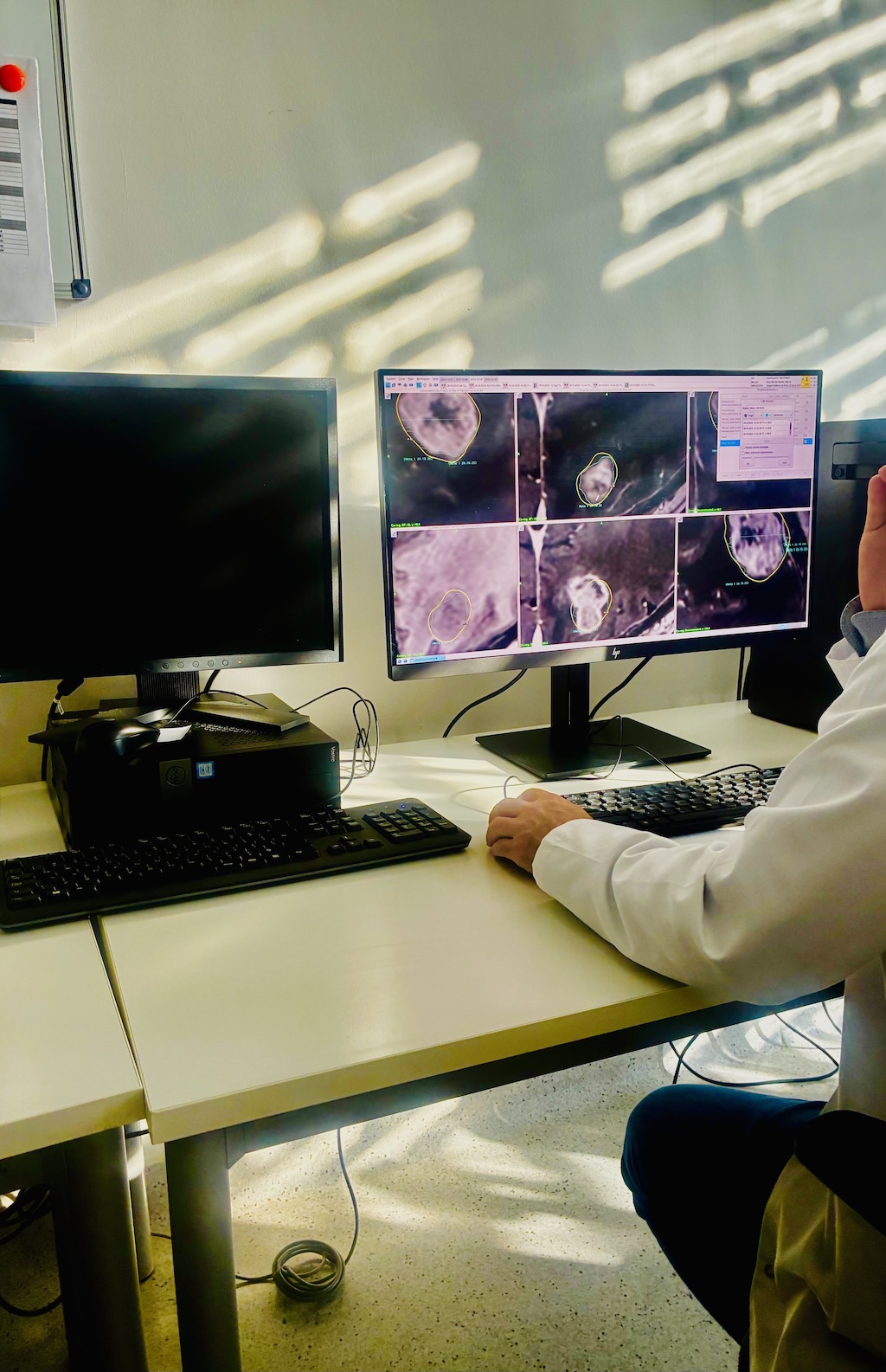 Gamma Knife – radiochirurgia stereotaktyczna, leczenie guzów mózgu