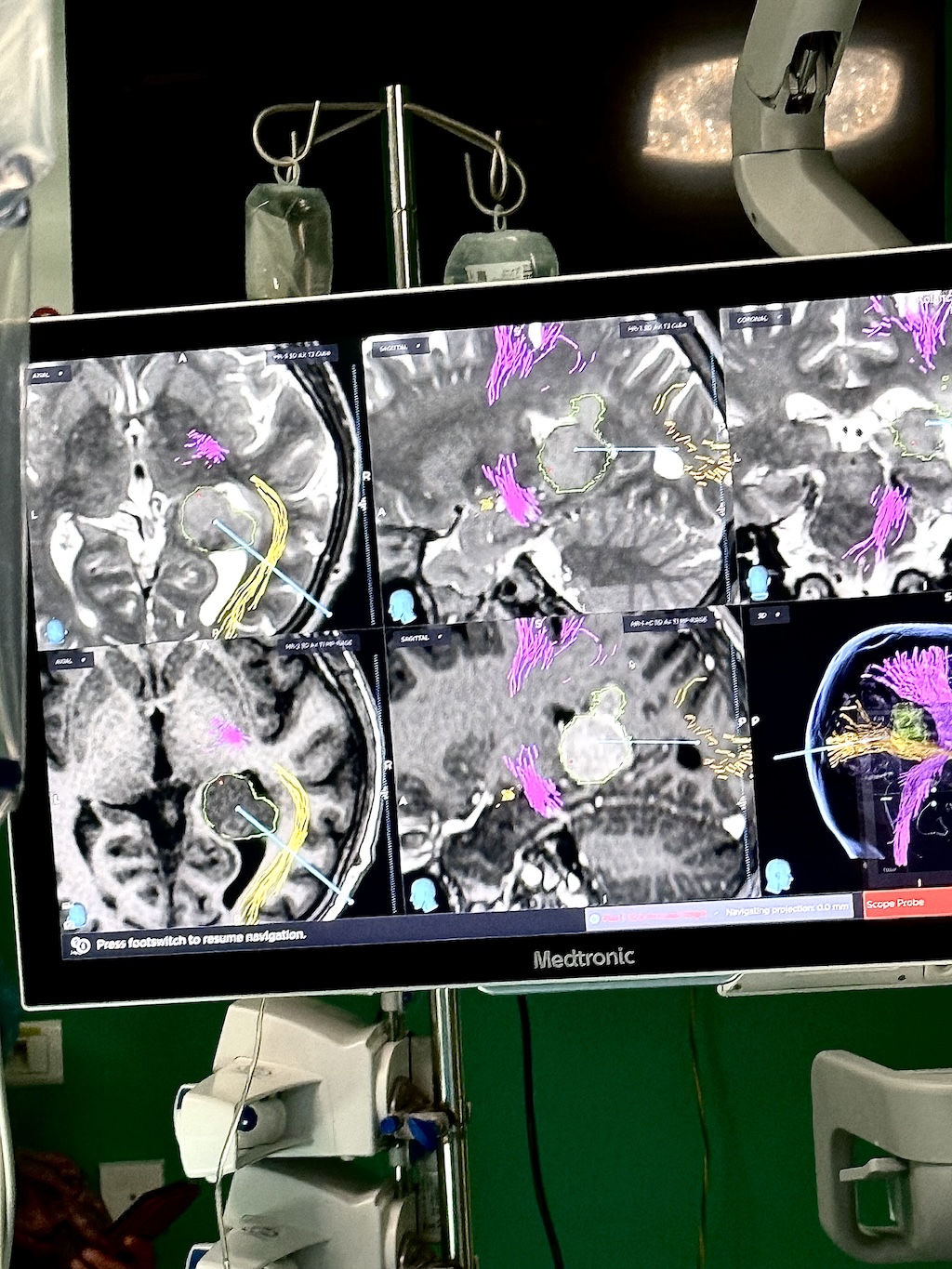 Traktografia DTI mózgu – planowanie operacji neurochirurgicznych, Katowice